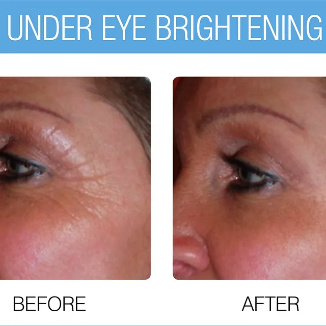 The Beauty Suite CACI Skinbreeze