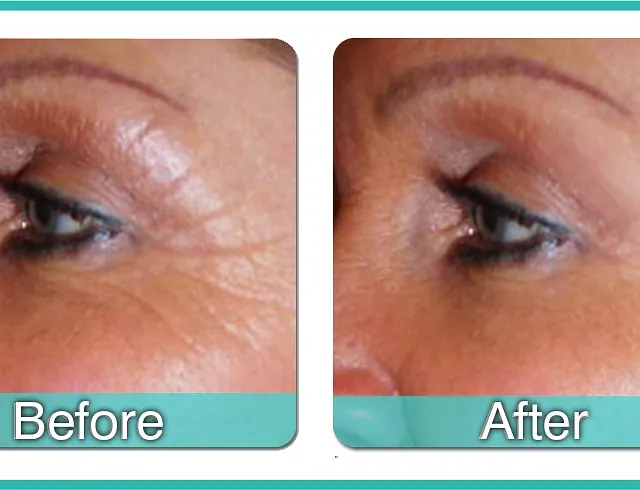 The Beauty Suite CACI Skinbreeze