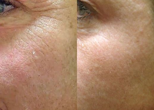 The Beauty Suite SkinPen 