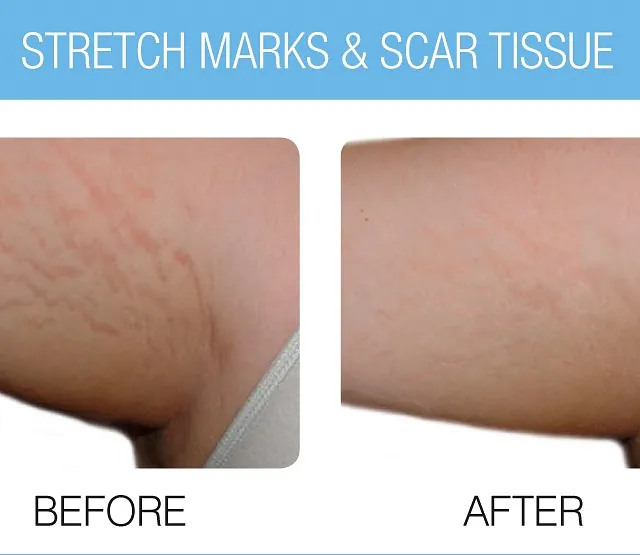 The Beauty Suite CACI Skinbreeze