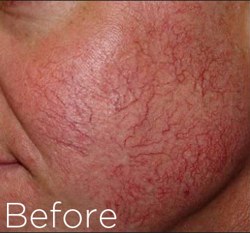 The Beauty Suite ThermaVein