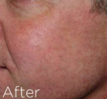 The Beauty Suite ThermaVein