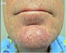 The Beauty Suite ThermaVein